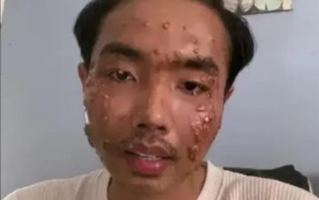 Seorang pengguna TikTok mengalami infeksi kulit usai mengenakan pakaian bekas alias cabo. dok. TikTok @onenevertwoo_one/Hibata.id