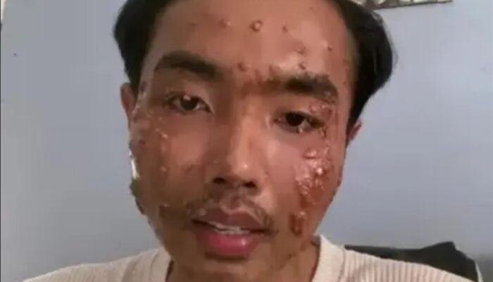 Bahaya Pakaian Cabo, Pria ini Terkena Penyakit Kulit Mengerikan