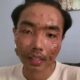 Seorang pengguna TikTok mengalami infeksi kulit usai mengenakan pakaian bekas alias cabo. dok. TikTok @onenevertwoo_one/Hibata.id