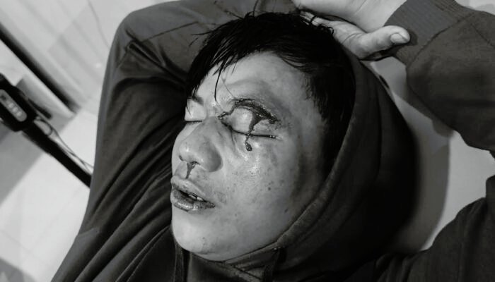 Korban Penganiayaan di Pohuwato Alami Kebutaan, Polisi Diminta Bertindak Adil