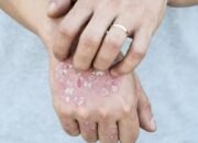 Ilustrasi - Kasus penyakit kusta di Kabupaten Pohuwato, Gorontalo, mengalami peningkatan/Hibata.id