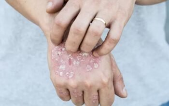 Ilustrasi - Kasus penyakit kusta di Kabupaten Pohuwato, Gorontalo, mengalami peningkatan/Hibata.id