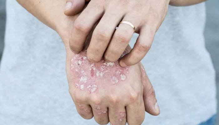 Kasus Kusta di Pohuwato Tembus 54, Ini Wilayah Terparah