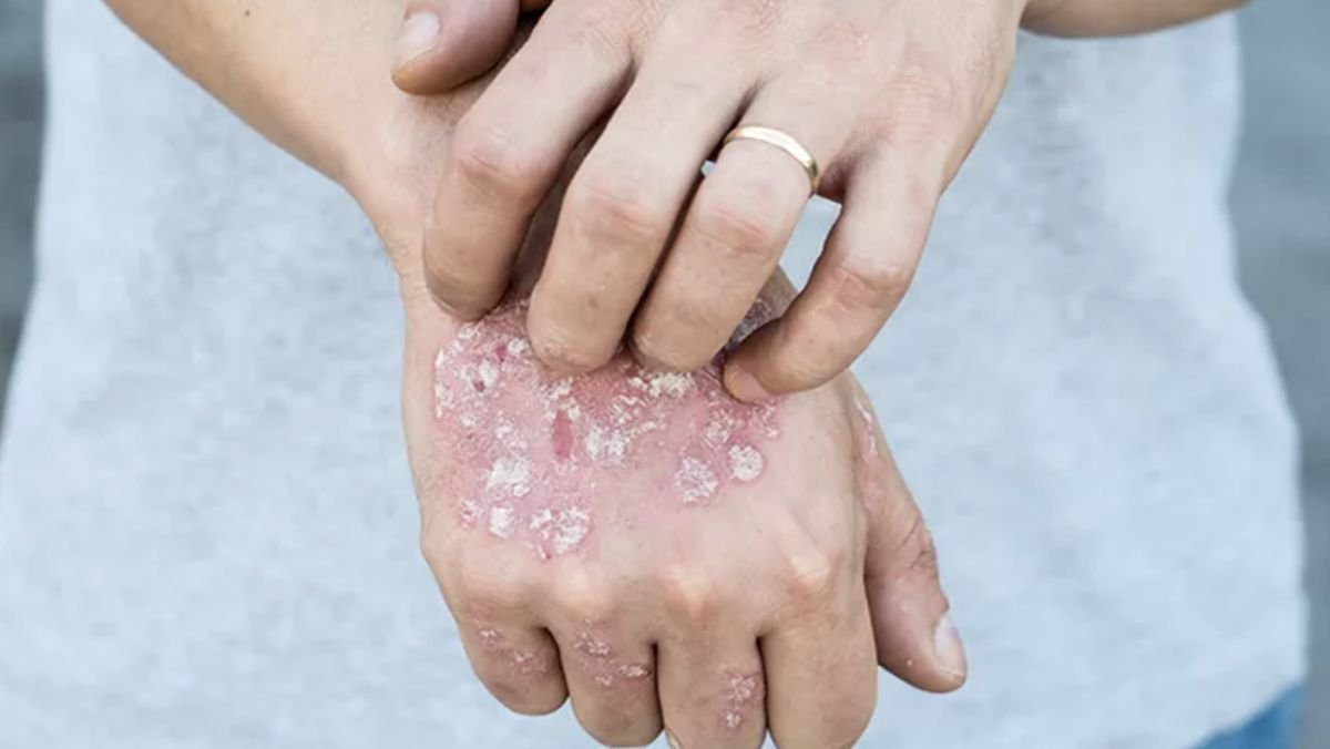 Ilustrasi - Kasus penyakit kusta di Kabupaten Pohuwato, Gorontalo, mengalami peningkatan/Hibata.id